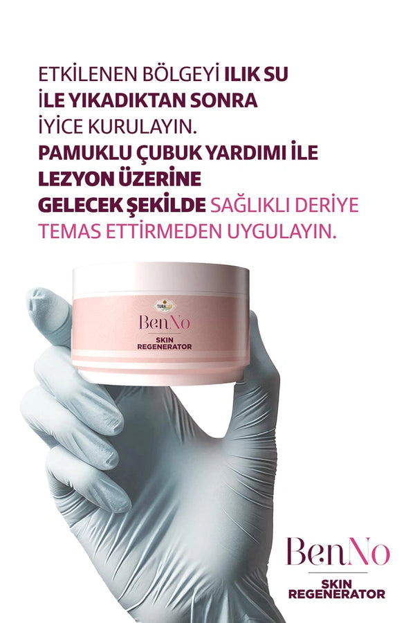 Genital siğil, et beni ve nasırlar için ameliyatsız ve etkili krem çözümü