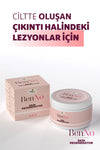 Cilt yüzeyinde oluşan çıkıntılı lezyonlara karşı etkili BenNo krem uygulaması